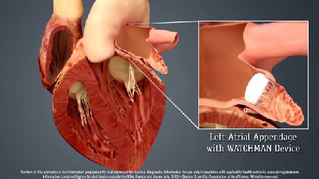 Left Atrial Appendage Closure with the WATCHMAN™ Device